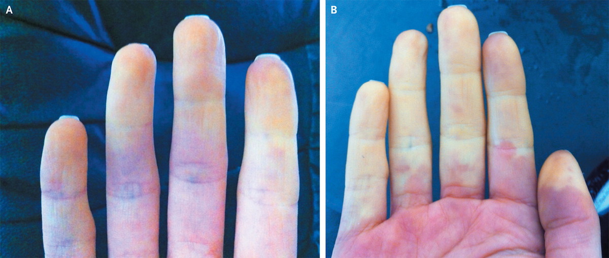 Understanding Raynauds Disease Things Health