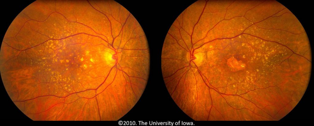 Macular Degeneration