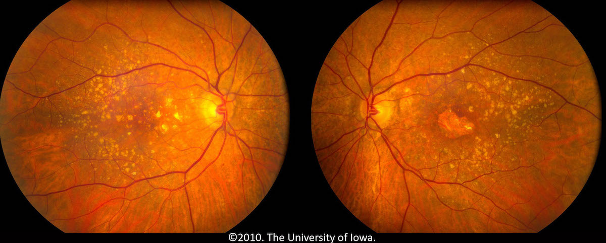 macular-degeneration-things-health