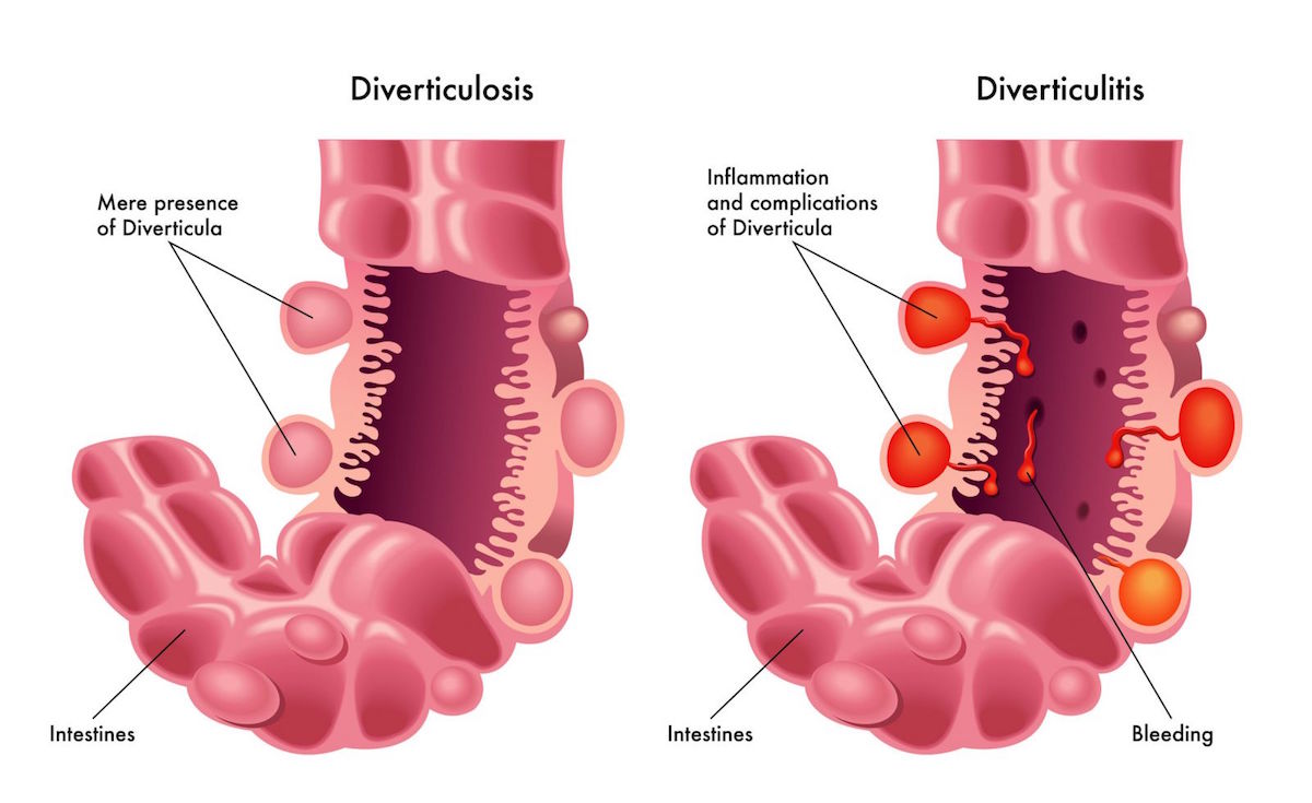 pooping-blood-here-are-some-common-causes-of-blood-in-stool-page-6