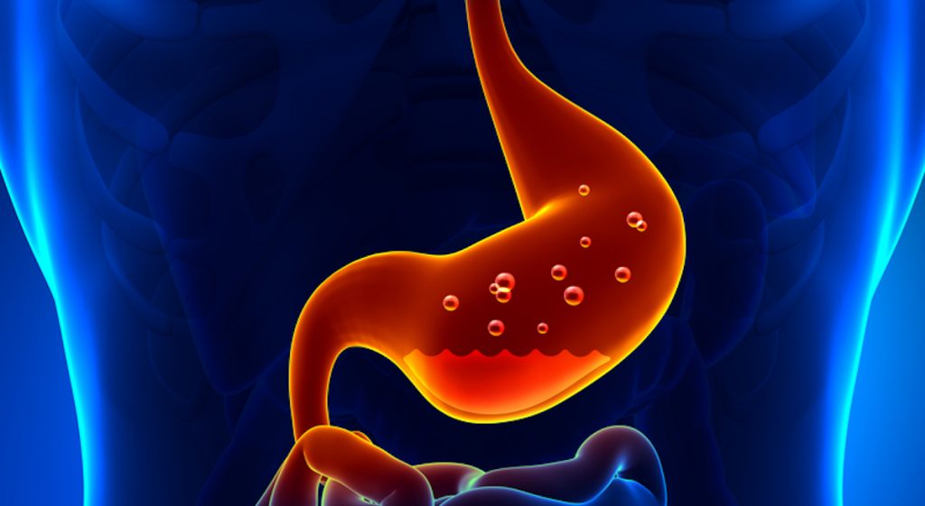 Acid Reflux, Hiatus Hernia Or Heartburn?