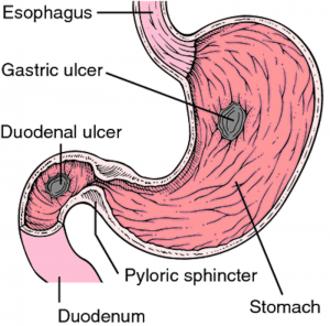 Pooping Blood? Here are Some Common Causes of Blood in Stool | Page 5 ...