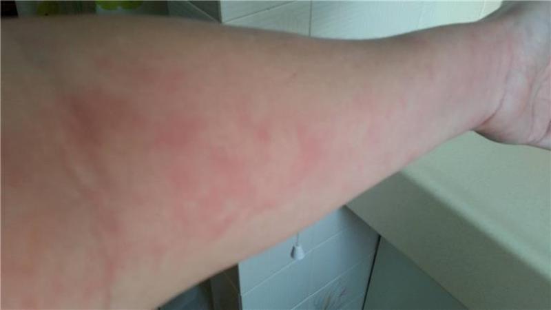 florid-rash-caused-by-vitamin-b12-injections-administered-by-nurse-in