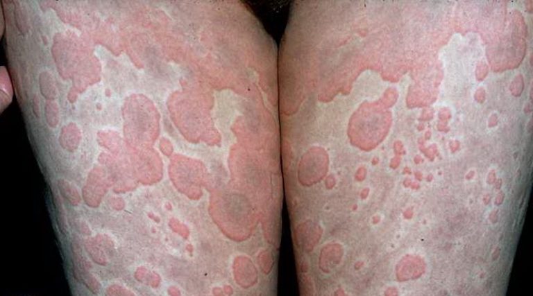 Serious Conditions That Rashes And Hives Can Indicate Page