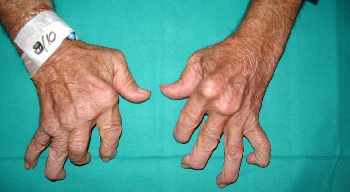 Symptoms Of Rheumatoid Arthritis Things Health