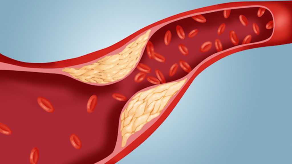 Cholesterol Management Plan