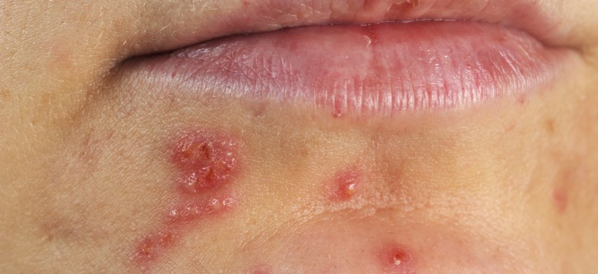 are-canker-sores-contagious