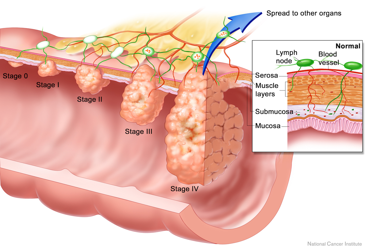 What Is Grade 2 Colon Cancer