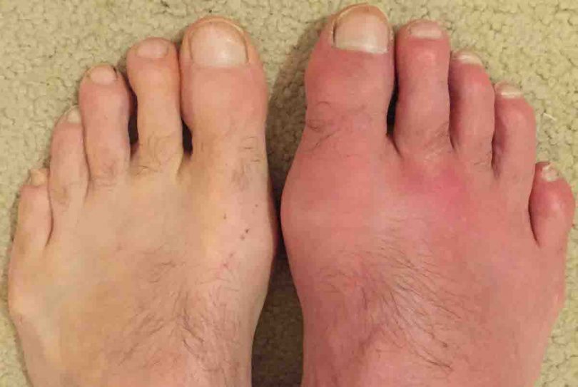 What Is Gout In Foot Symptoms