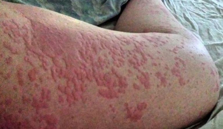 10 Serious Conditions That Rashes And Hives Can Indicate Page 6