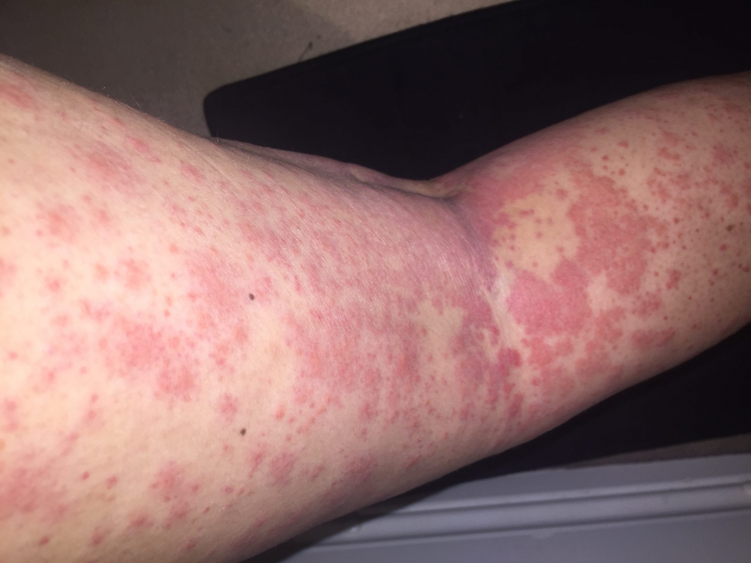 serious skin rashes that itch