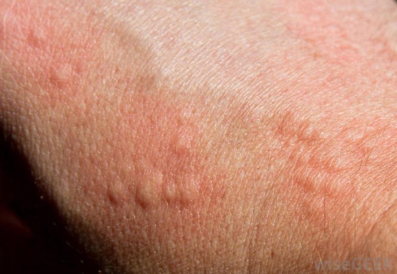 10 Serious Conditions That Rashes And Hives Can Indicate