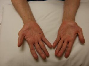 Bilateral Carpal Tunnel Syndrome | Things Health