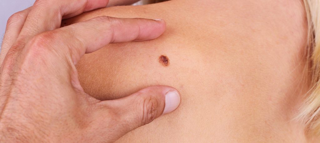 Types Of Skin Cancer