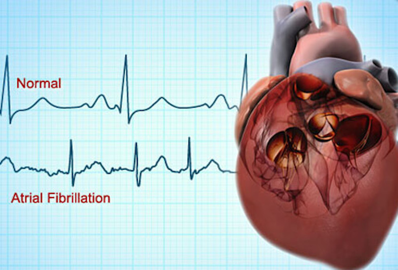 atrial fibrillation fluid retention