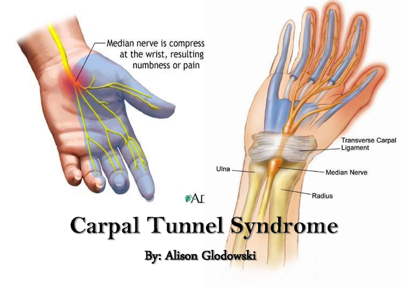 What Does Bilateral Carpal Tunnel Syndrome Mean