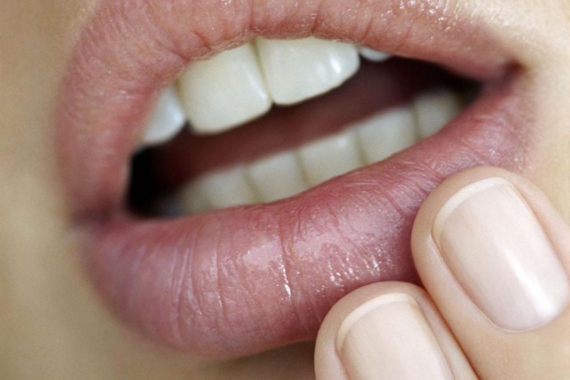 6 Reasons Why You Might Get Cold Sores Page 5 Things Health