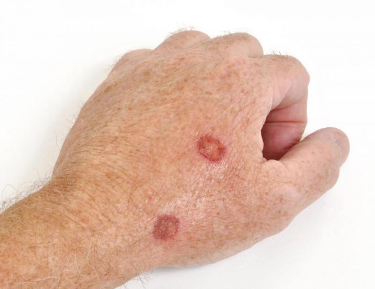 warning-signs-and-symptoms-of-non-melanoma-skin-cancer-page-4