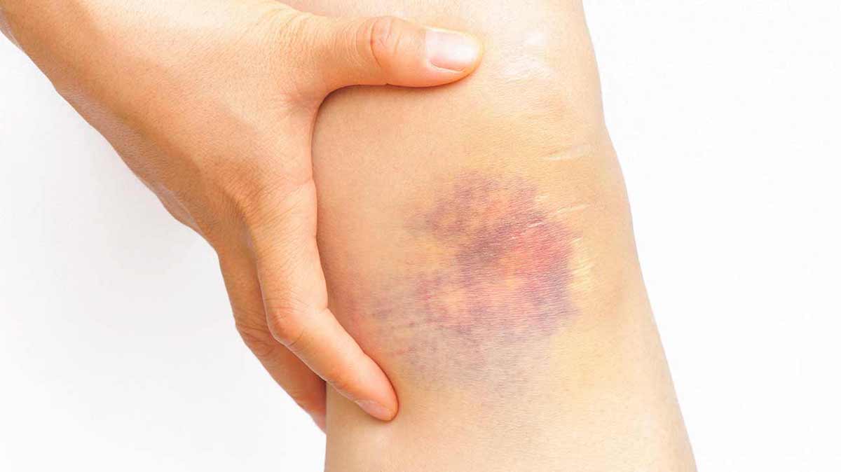 When Bruising Is Sign Of Cancer