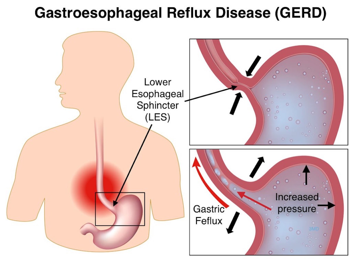 can-acid-reflux-cause-stomach-pain