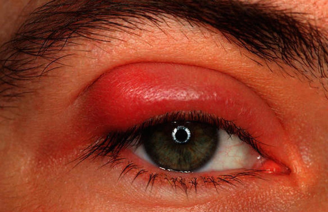 Pink Eye (conjunctivitis) Symptoms and Treatment Page 4 Things Health