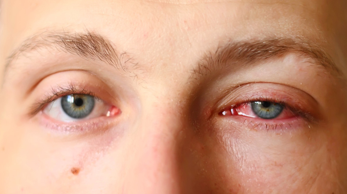 Pink Eye (conjunctivitis) - Symptoms and Treatment | Page 8 | Things Health