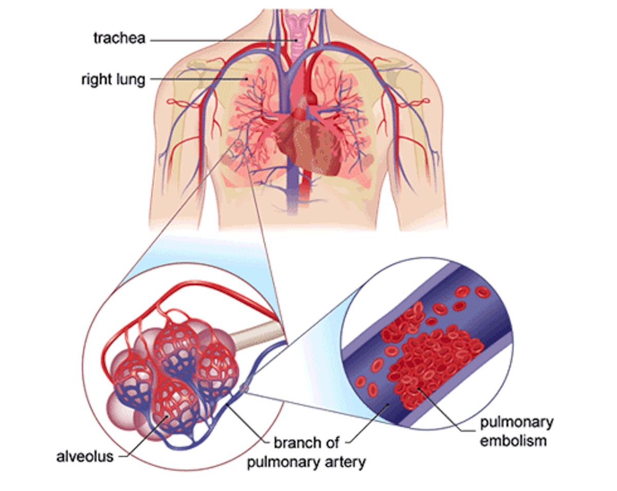 Тромбозы и эмболии артерий