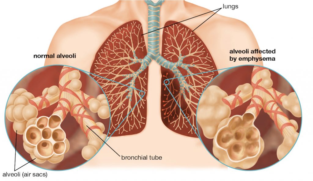 understanding-atrial-fibrillation-heart-health-blogs