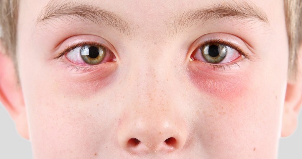 Pink Eye (conjunctivitis) - Symptoms and Treatment | Things Health