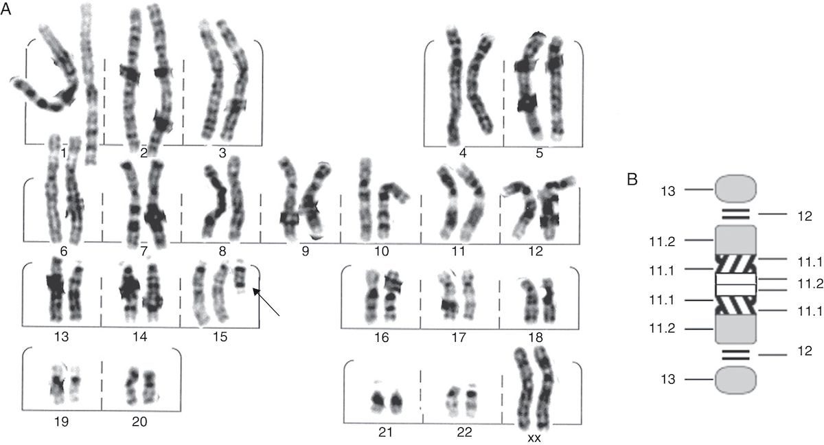 Спаривание хромосом. Синдром Ангельмана кариотип. Синдром Микроделеции 15 хромосомы.