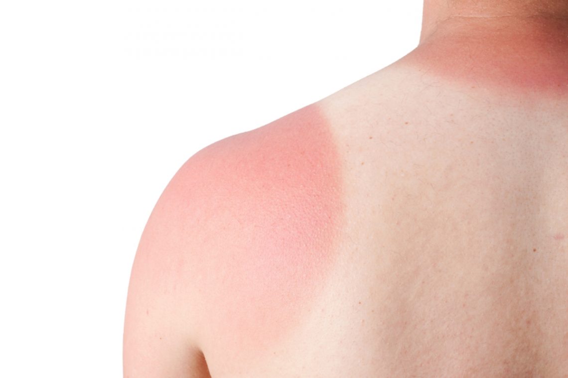 Signs, Symptoms and Risk Factors of Lupus | Page 10 | Things Health