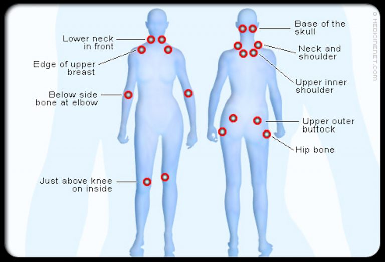 The Most Common Symptoms of Fibromyalgia | Page 2 | Things Health