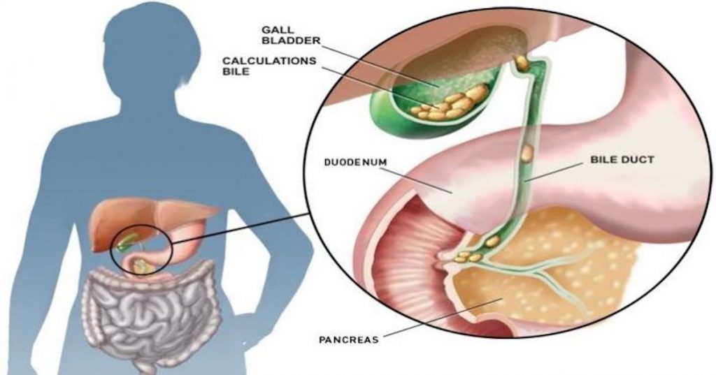 10 Common Causes of Gallstones | Page 3 | Things Health