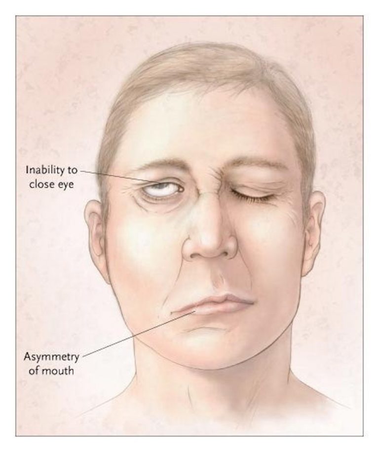 12 Common Myths About Strokes Page 5 Things Health