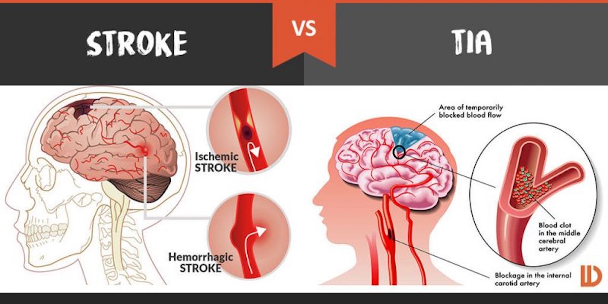 12-common-myths-about-strokes-page-4-things-health