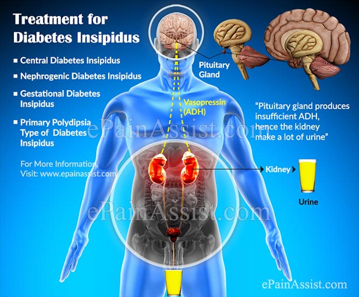 Symptoms And Treatment Of Diabetes Insipidus Page 5 Things Health