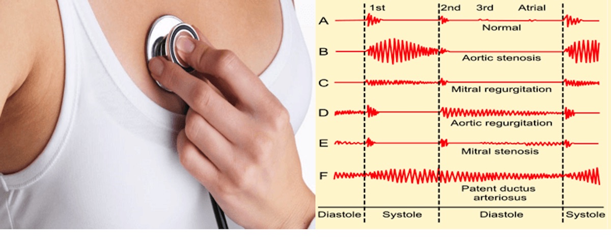 Does A Heart Murmur Affect Resting Heart Rate