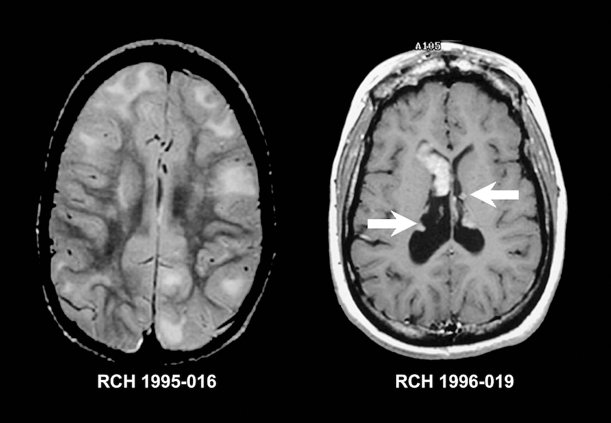 What Are White Spots On The Brain In Mri