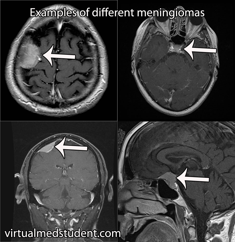 Менингиома это. Менинготелиальная менингиома. Оссифицированные менингиомы. Опухоль головного мозга менингиома. Менингососудистые опухоли головного мозга.