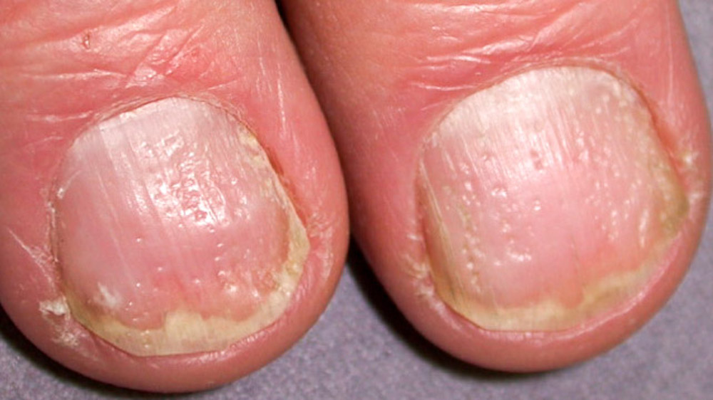 What Causes Bumps On Fingernails