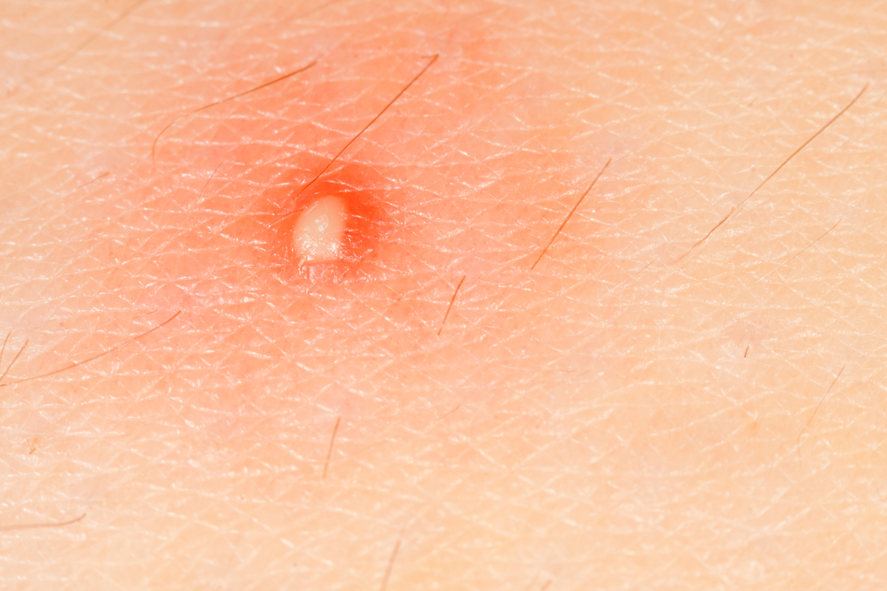 How Do I Know If My Staph Infection Is Spreading