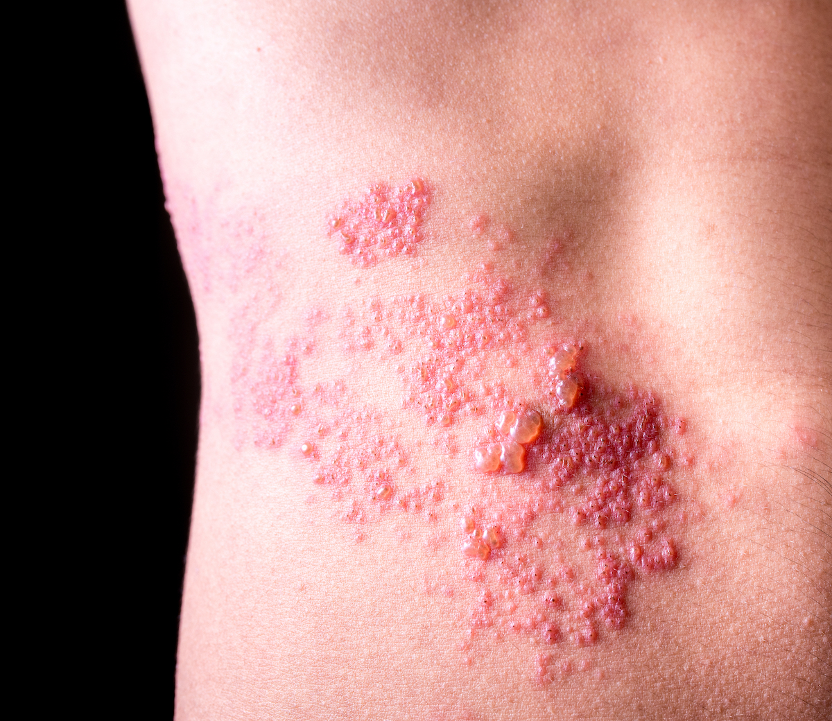 Warning Signs Of Shingles Things Health Warning Signs Of Shingles Things Health
