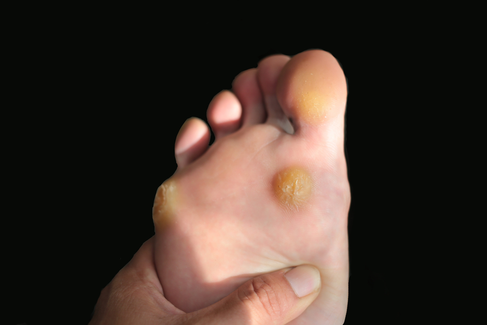 how-to-treat-a-painful-callus-on-foot