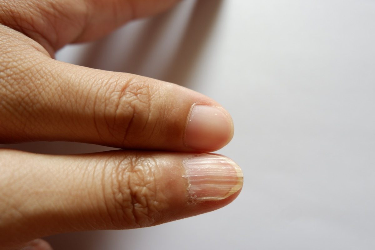 Signs You May Be Anemic