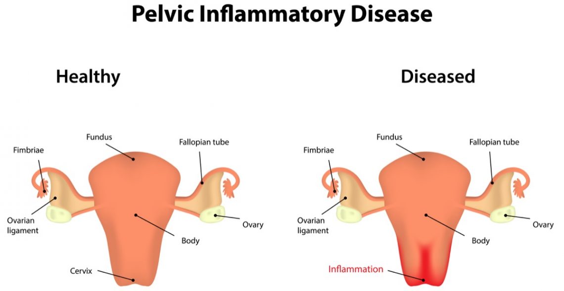 why-you-shouldn-t-ignore-pelvic-pain-darin-l-weyhrich-m-d-obgyn