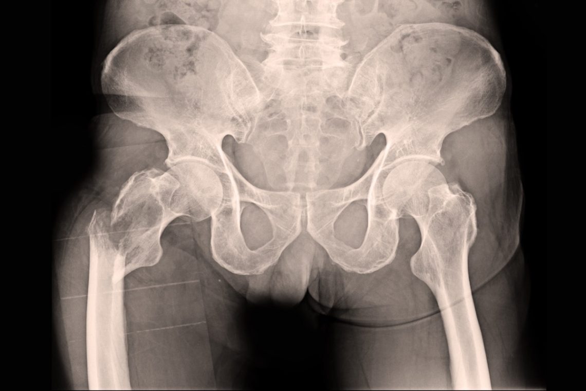 hip pain but xray normal