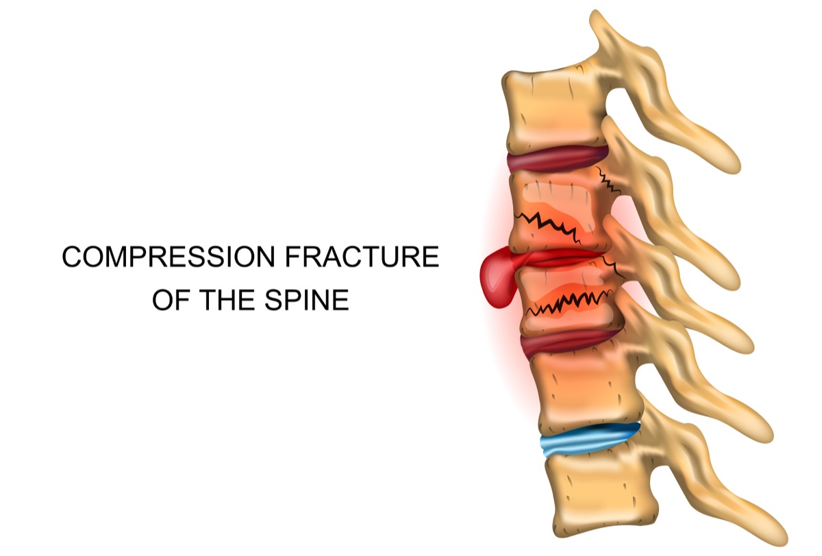 back pain compression fracture treatment