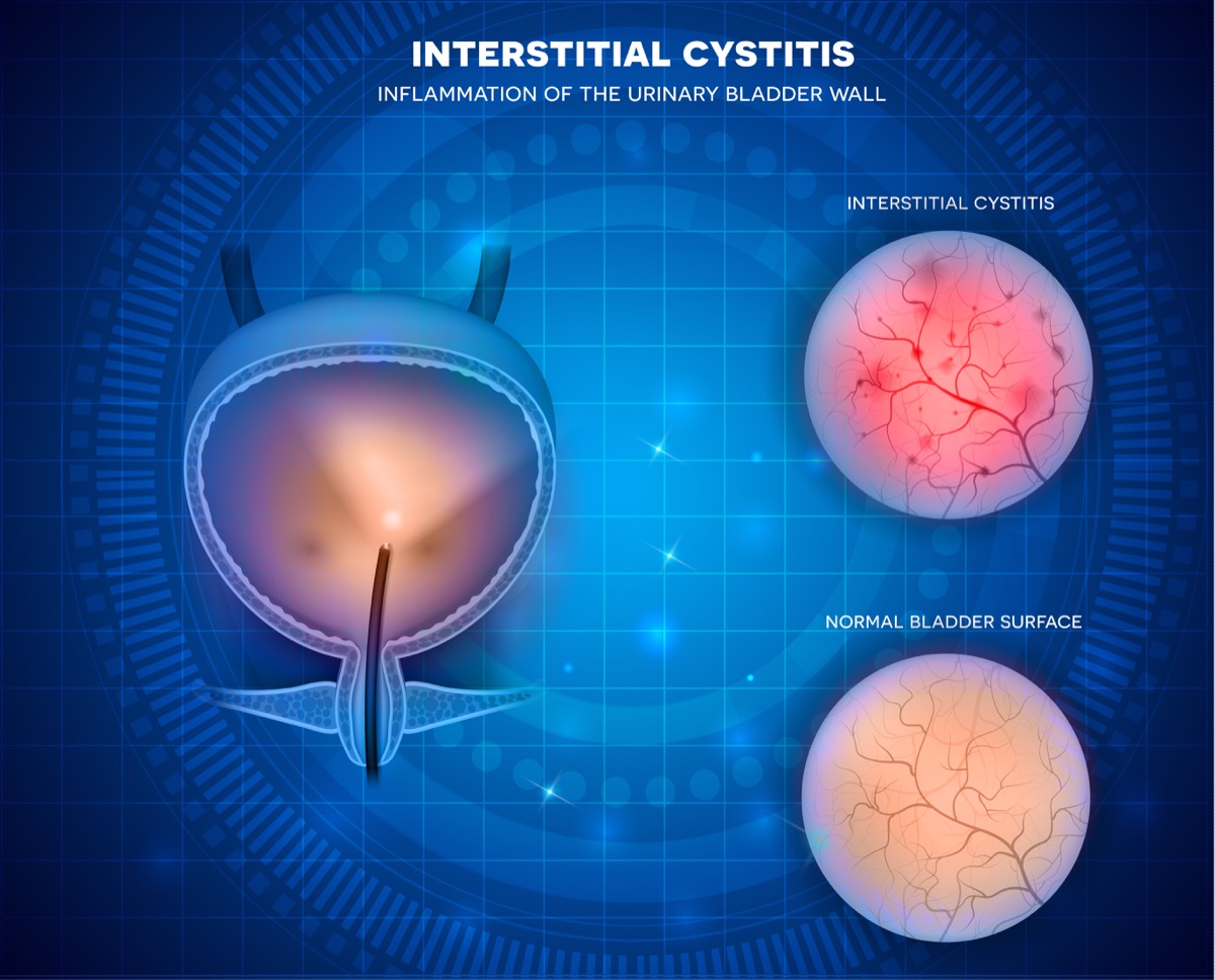 Interstitial Cystitis.