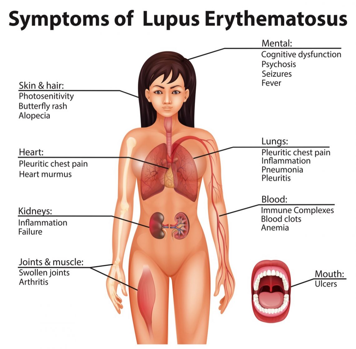 the-most-common-symptoms-of-lupus-page-16-things-health