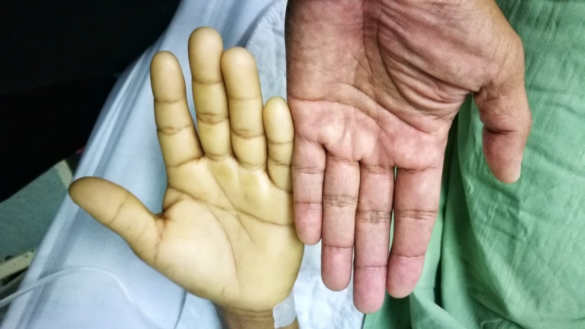 The Most Common Symptoms of Lupus Page 13 Things Health